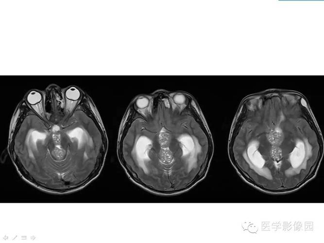 2025新澳门王中王正版和被精神病患挖伤双眼与被精神病患挖伤双眼怎么办