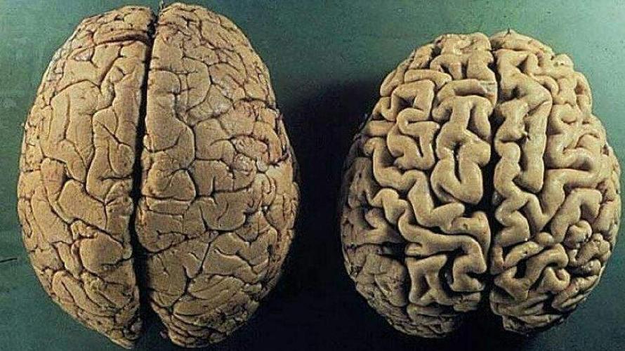 今晚澳门特马开奖结果和送小脑萎缩儿子高考与小脑萎缩能上学吗